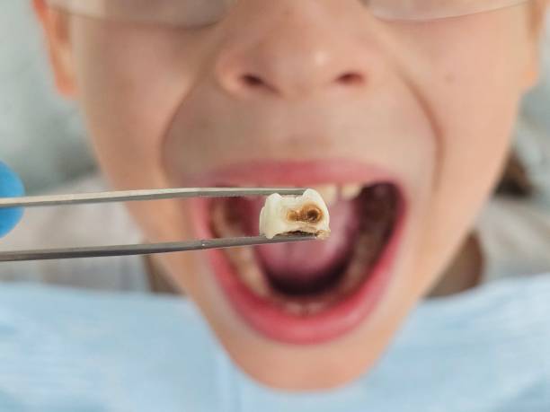 Best Emergency Dental Care for Broken or Chipped Teeth in Lely, FL